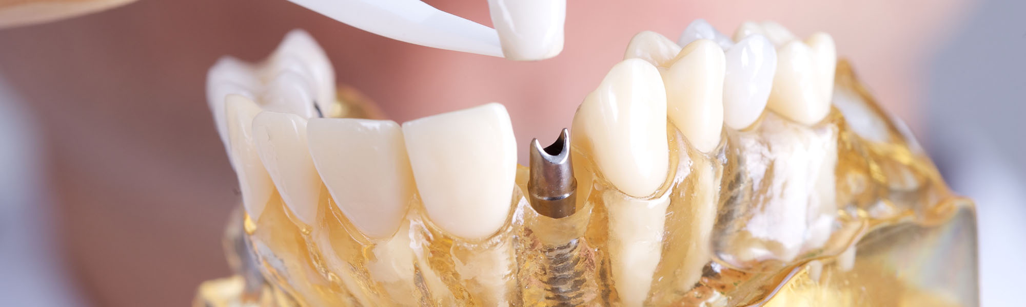 Dental FAQ Questions