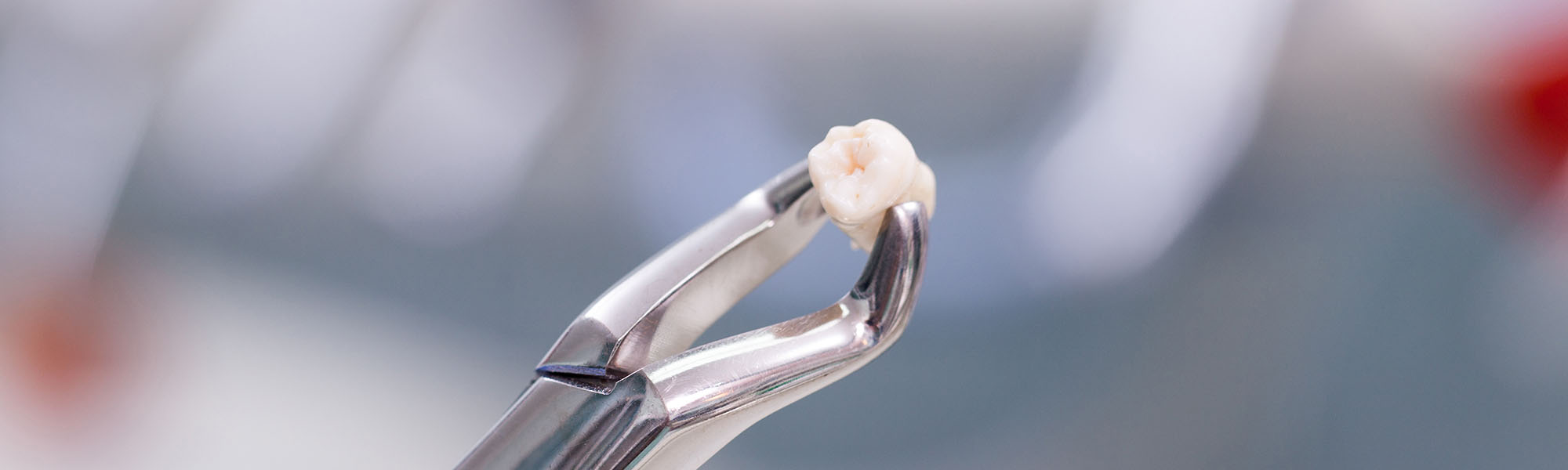 Tooth Extraction Long Beach CA