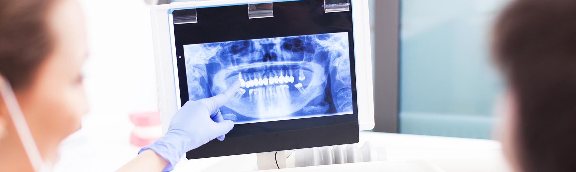 Teeth Extraction in Long Beach CA