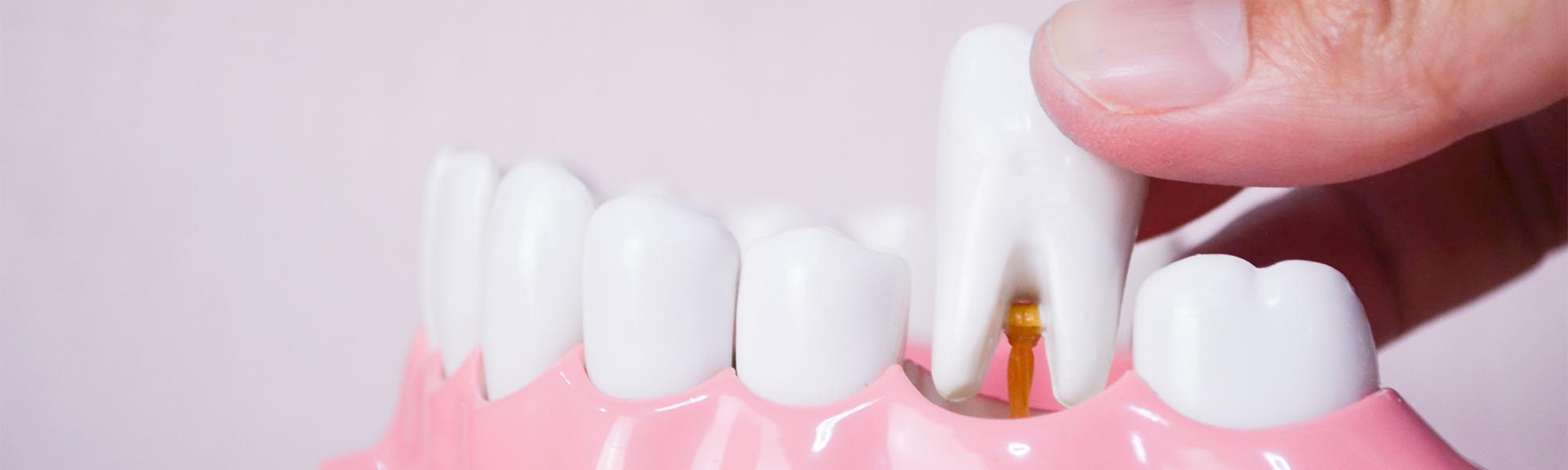 Tooth Extraction in Long Beach CA