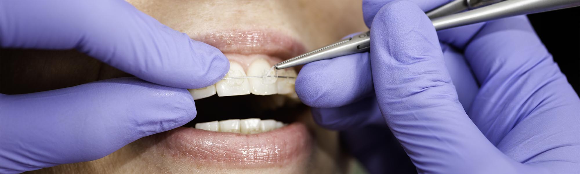 Porcelain Ceramic Braces in Long Beach CA