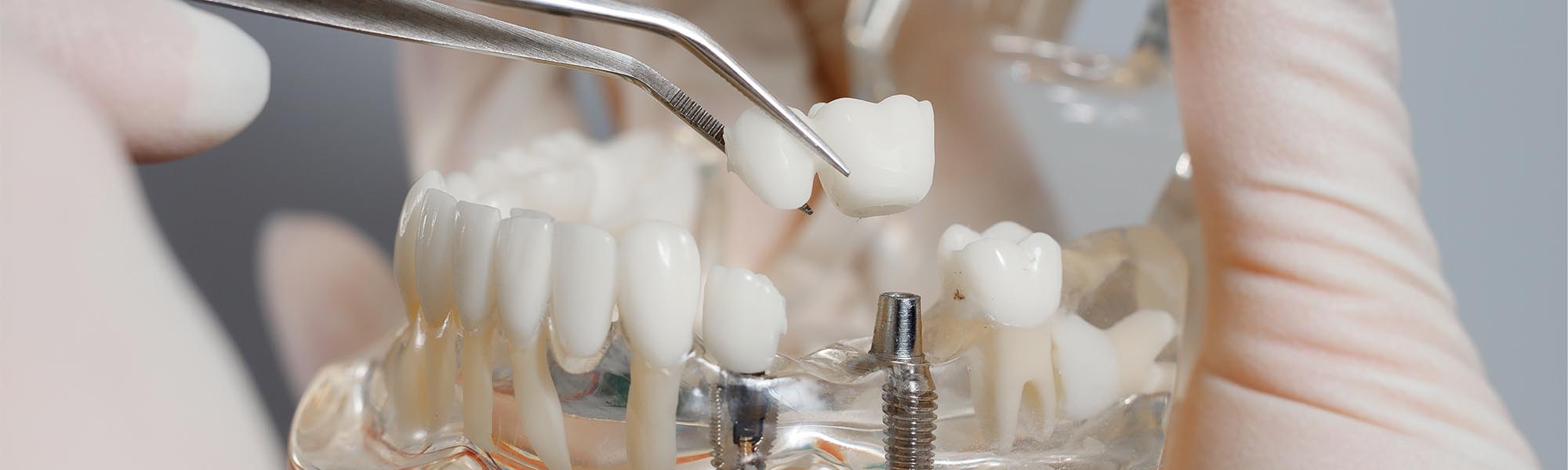 Multiple Teeth Implants Dentistry Long Beach CA