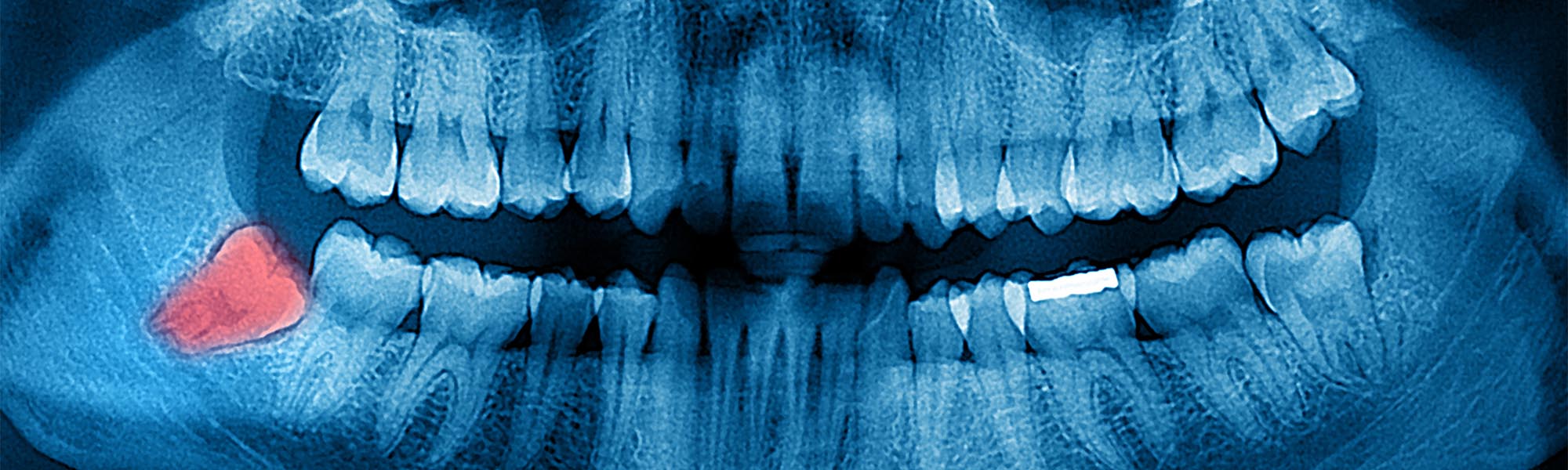 Extraoral Digital X-rays in Long Beach CA